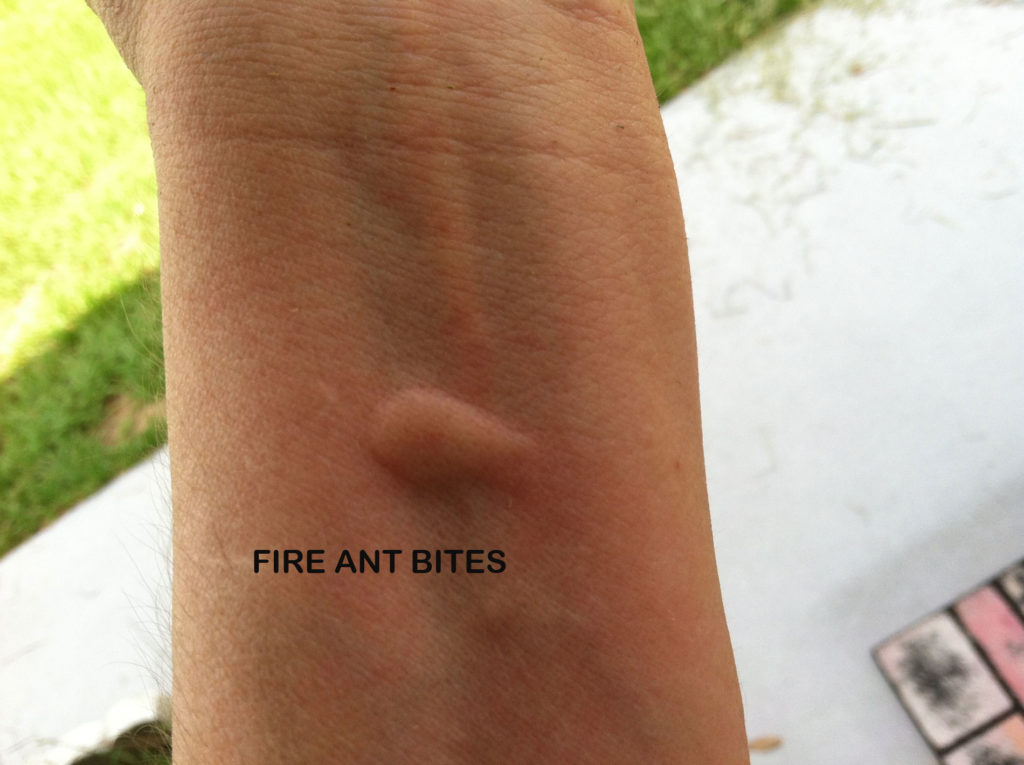 fire-ant-bites